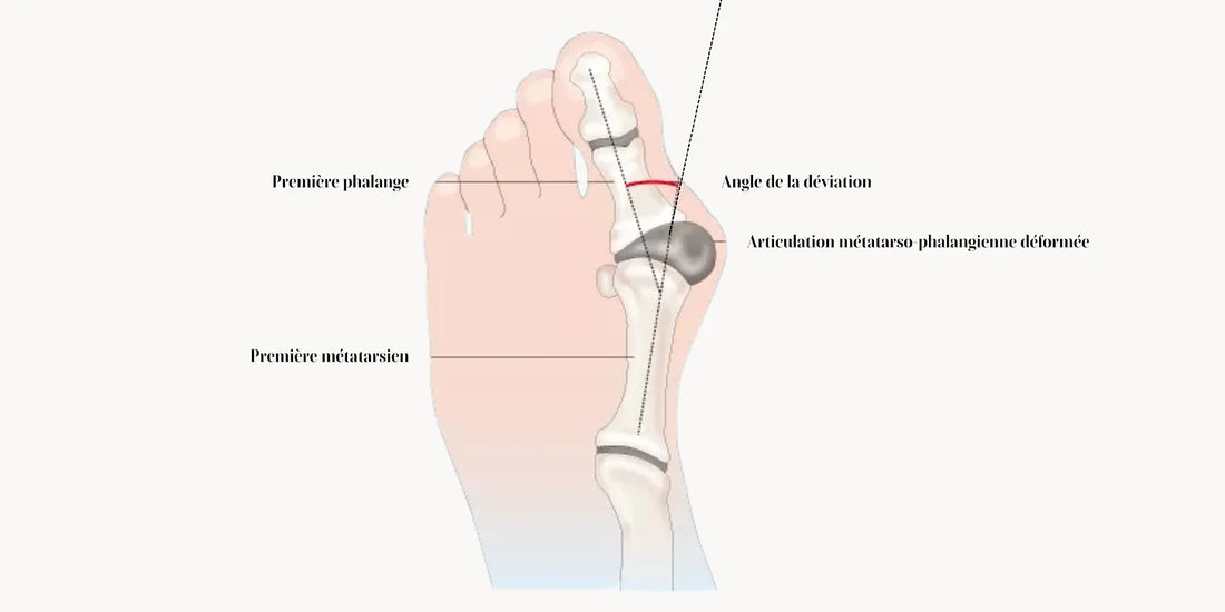 Hallux Valgus : tout savoir sur la prévention et la prise en charge.